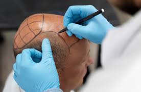 How Modern Techniques Improve Hair Density and Natural Appearance