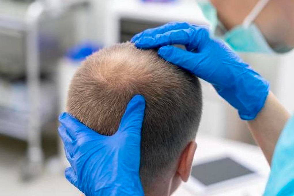 How Do Specialists Ensure Successful Hair Transplant Outcomes?