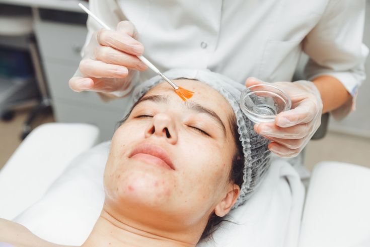 How Long Does PCA Peel Treatment Recovery Take Time?