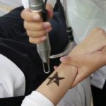 Fast Tattoo Removal in Dubai | Lymphatic Drainage & Fading Tips