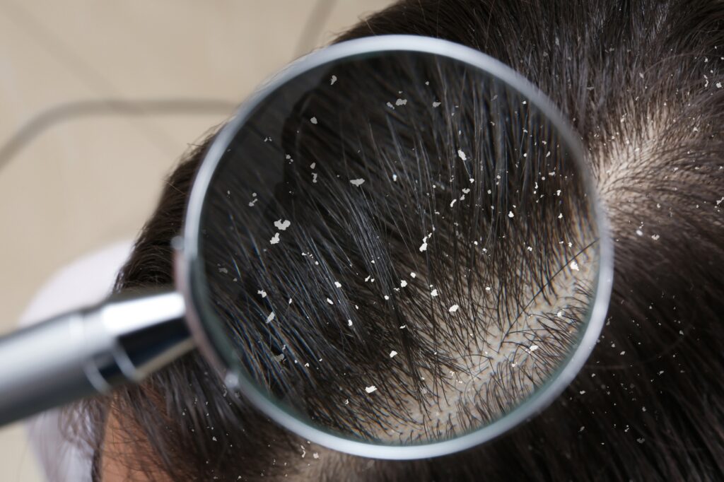Complete Guide for Best Anti-Dandruff Shampoo & Hair Care