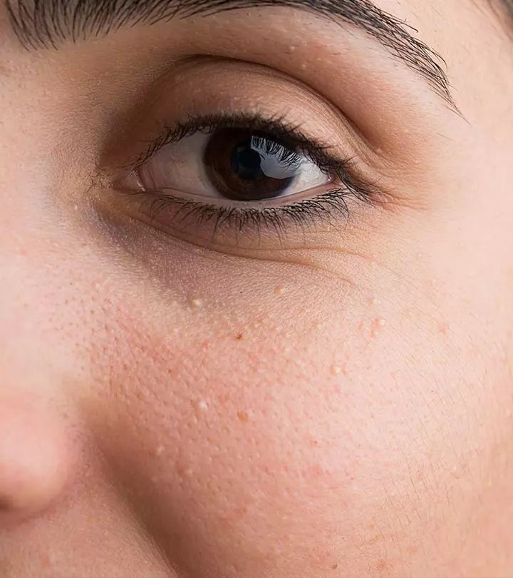 Can Milia Treatment Reduce Visible Skin Imperfections?