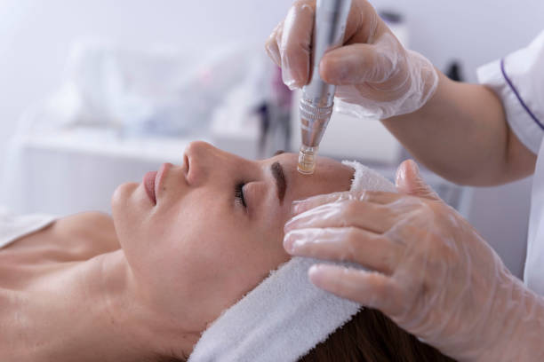 Microneedling Treatment in Dubai for Surgical Scars | Repair