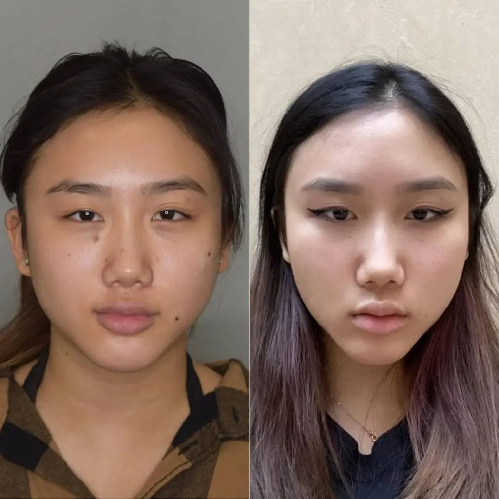 Ethnic Facial Considerations in Buccal fat removal Surgery in Dubai