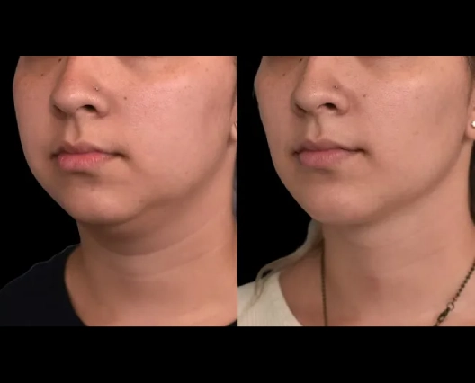 Beauty Confidence and Double chin removal Surgery in dubai