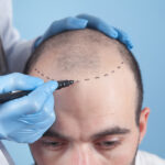 Design Features That Improve Realism in Hair Replacement Systems