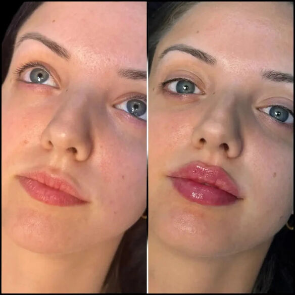 Experience Expert Care from the Best Doctors in Dubai for Fillers