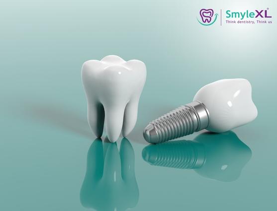Benefits of Early Cavity Treatment – Why Timely Dental Care Protects Your Smile