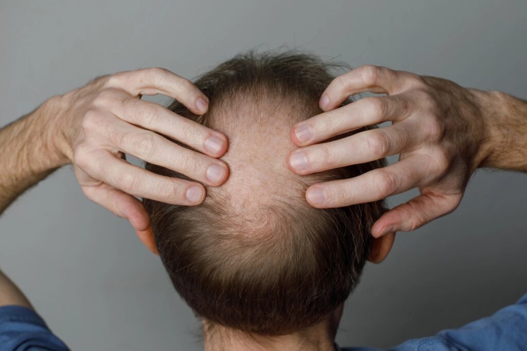 How Clinics Evaluate Progress During Alopecia Treatment