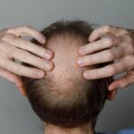 How Clinics Evaluate Progress During Alopecia Treatment