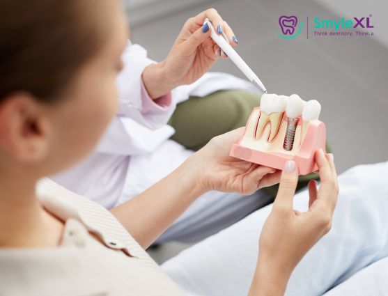 How Many Visits Are Needed for Dental Implant Treatment?