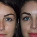 Best Rhinoplasty Surgeon in Dubai for Asian Rhinoplasty