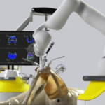 Robotic Knee Replacement: A Smarter Way to Treat Severe Knee Pain