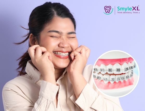 Can Braces Treatment Fix Jaw Alignment Problems?