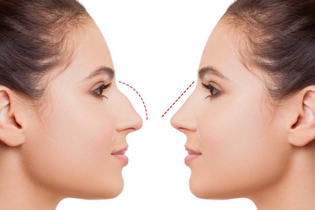 Rhinoplasty in Islamabad and nasal angle correction