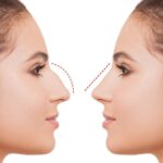 Rhinoplasty in Islamabad and nasal angle correction