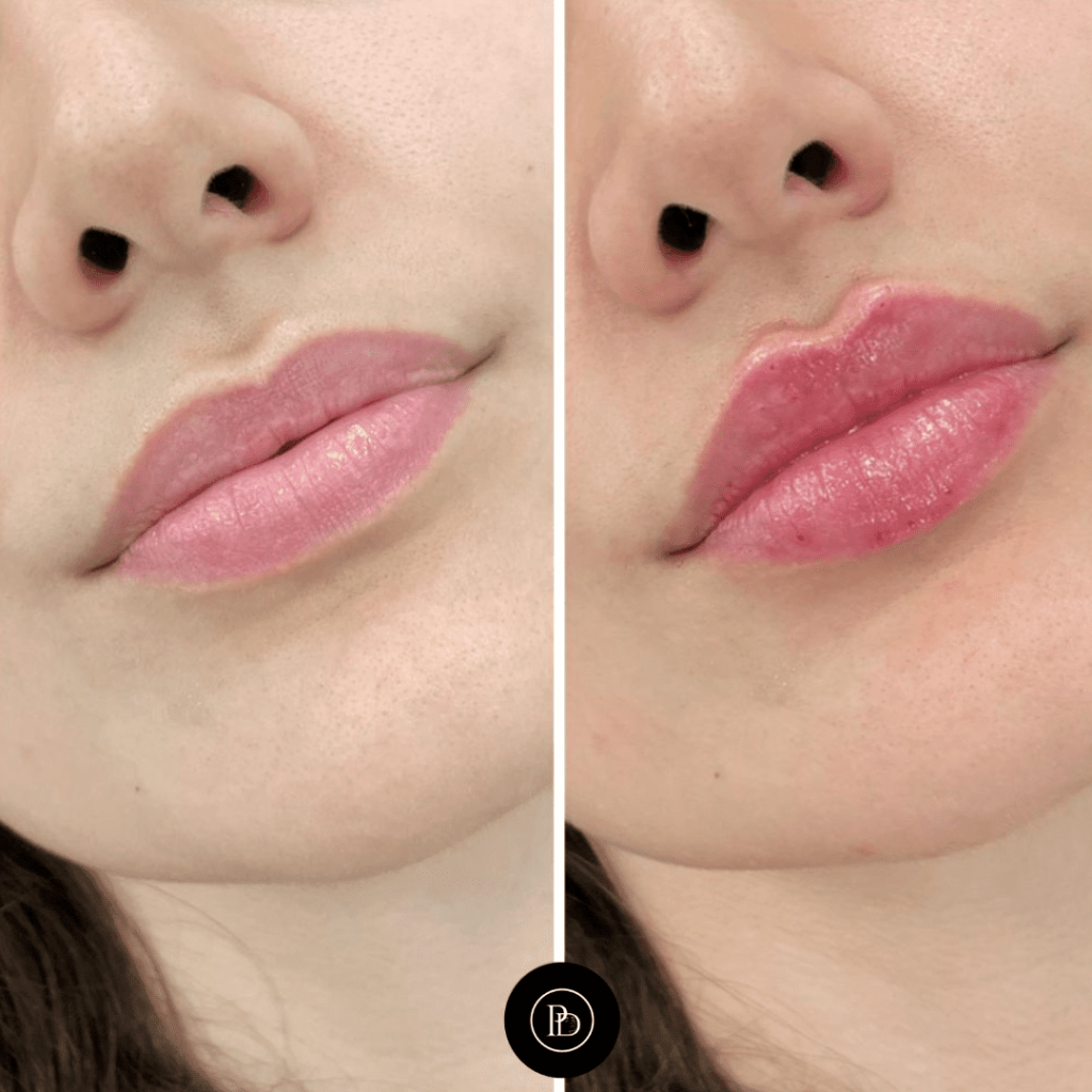 Juvederm Lip Filler Maintenance Tips from the Best Plastic Surgeons in Dubai