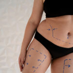 Liposuction in Dubai: Is It Worth It? Costs vs Results Explained