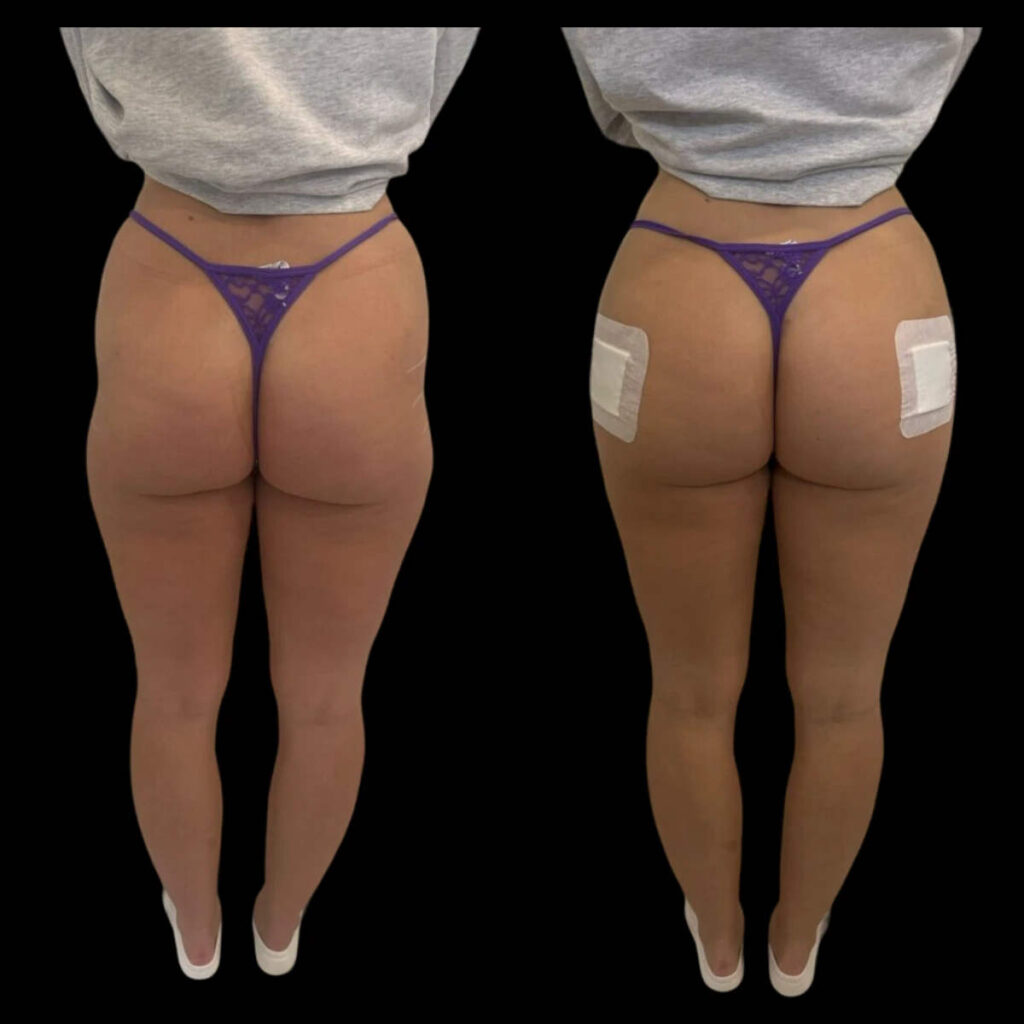 Benefits of Choosing Hyacorp Fillers in dubai for Long-Lasting Aesthetic Results