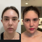 Jawline Enhancement with Buccal fat removal Surgery in Dubai