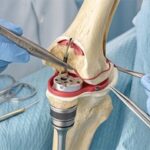 Why Knee Replacement Can Be a Life-Changing Decision