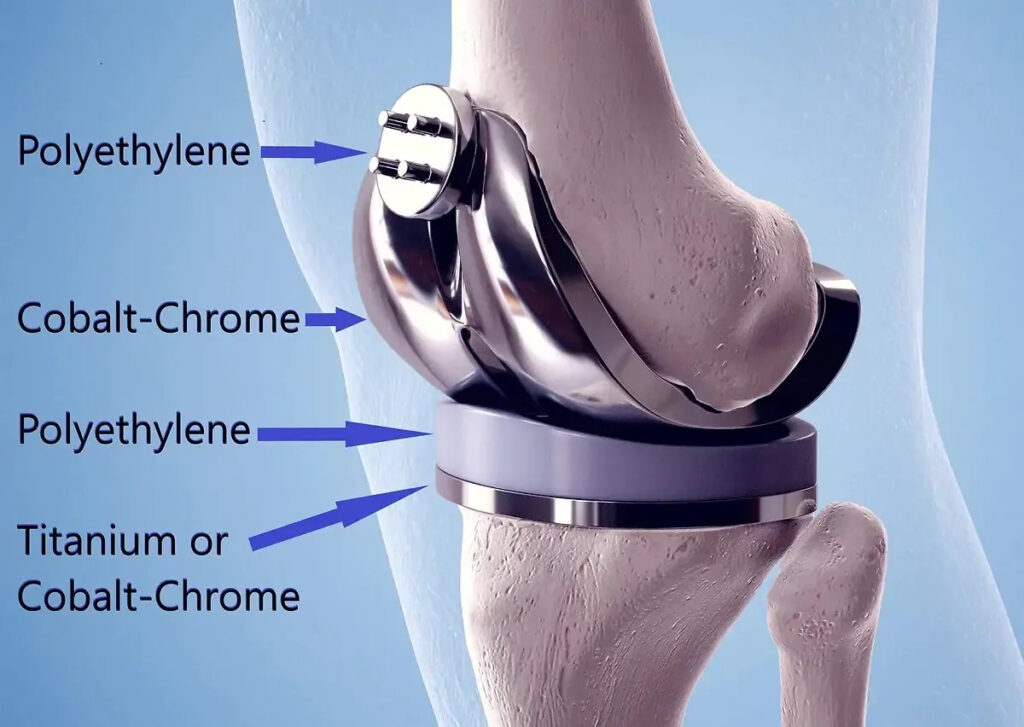What Are Knee Implants Made Of? A Complete Patient Guide