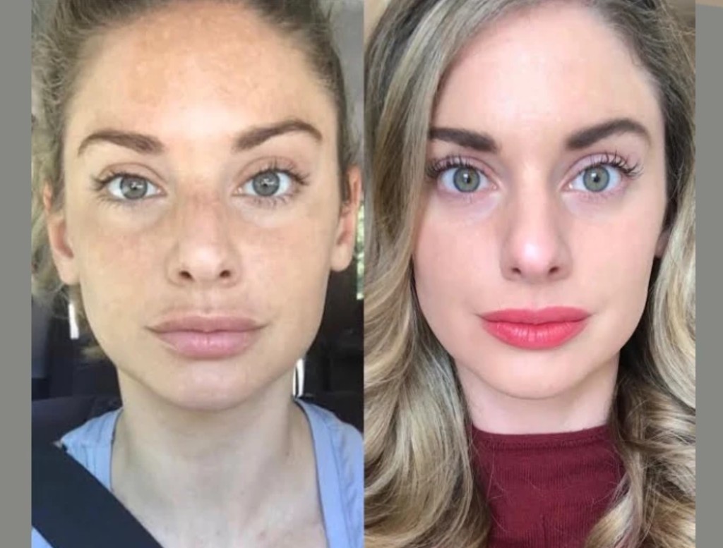 Radiant Skin Solutions by the Best Plastic Surgeons in Dubai for RF Microneedling