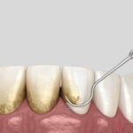 Dental Teeth Cleaning: Everything You Should Know