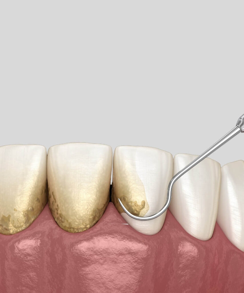 Dental Teeth Cleaning: Everything You Should Know