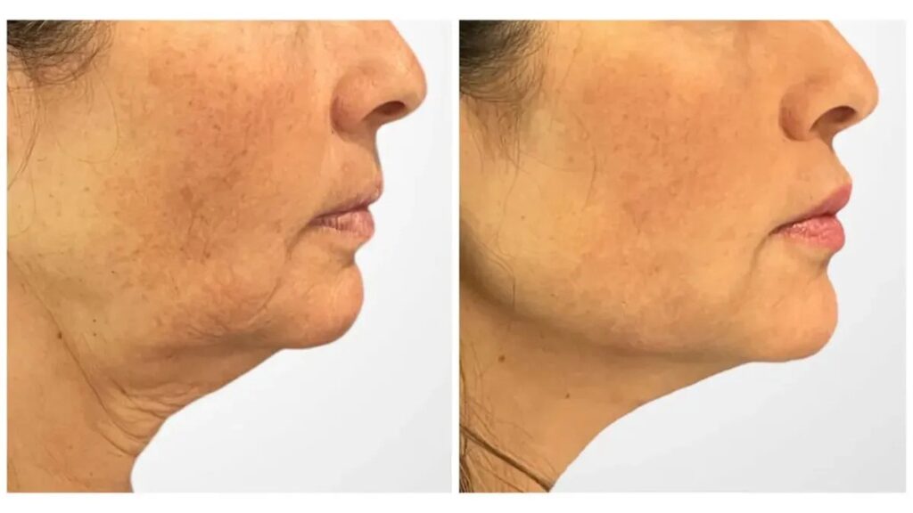 Thread Lift with Best Plastic Surgeon in Dubai Modern Beauty Innovations