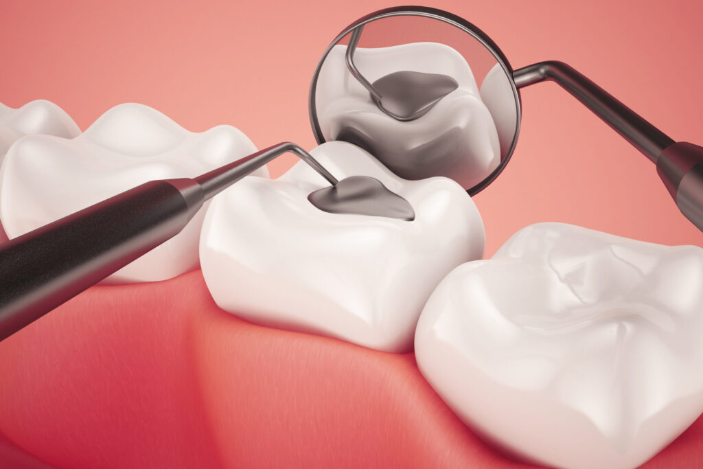 Protect Your Smile with Early Cavity Fillings