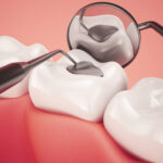 Protect Your Smile with Early Cavity Fillings