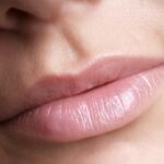 Does Lip Reduction Help Achieve Subtle Lip Changes?