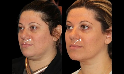 Sculptra Treatment in Dubai for Slim Waist Contouring