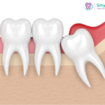 Is Removing a Wisdom Tooth Risky?