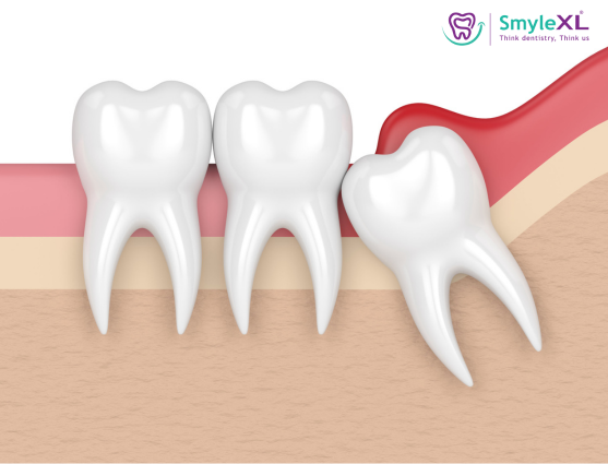 Is Removing a Wisdom Tooth Risky?