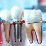 How Dental Implant Treatment Restores Your Smile