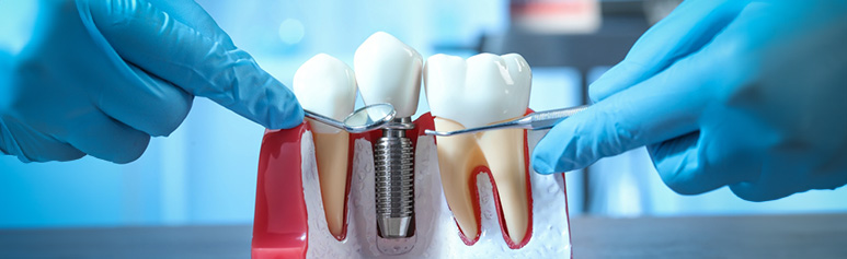How Dental Implant Treatment Restores Your Smile
