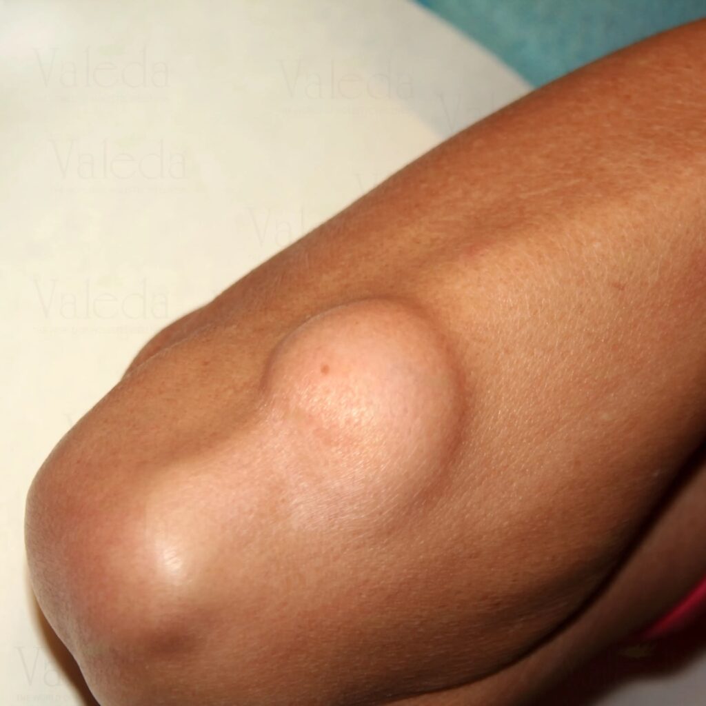 Lipoma Treatment for Smooth Skin Results