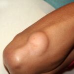 Lipoma Treatment for Smooth Skin Results