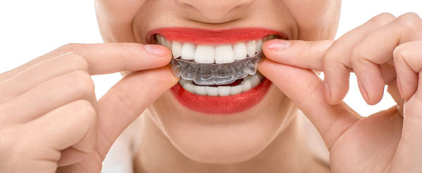 Benefits of Choosing Invisible Braces for Your Smile