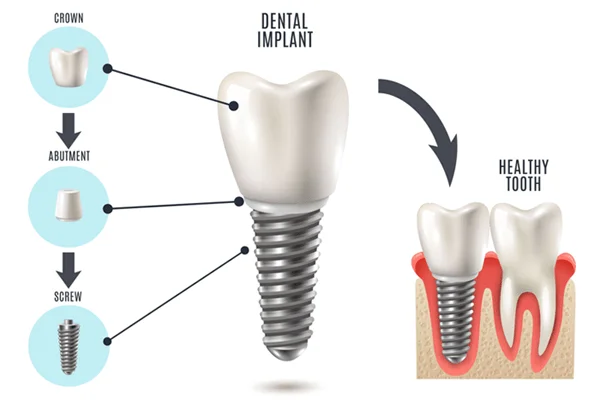 Why Choosing the Right Implantologist Matters