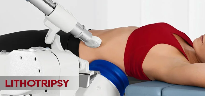 Kidney Stone Relief: Understanding Lithotripsy Treatment