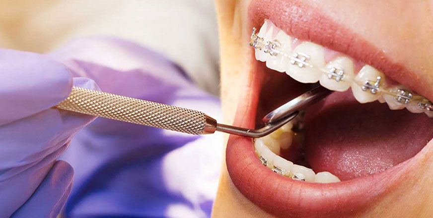 Braces Treatment Explained: What to Expect