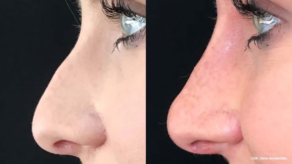 How Rhinoplasty Surgeons in Dubai Plan Your Procedure