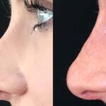 How Rhinoplasty Surgeons in Dubai Plan Your Procedure