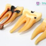 What Is the New Procedure Instead of a Root Canal?