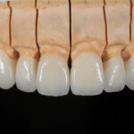 Is Zirconia Crown in Islamabad Worth It? Expert Dental Insights