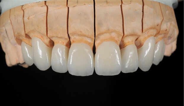 Is Zirconia Crown in Islamabad Worth It? Expert Dental Insights