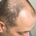 Advanced Hair Restoration Solutions for Alopecia Patients